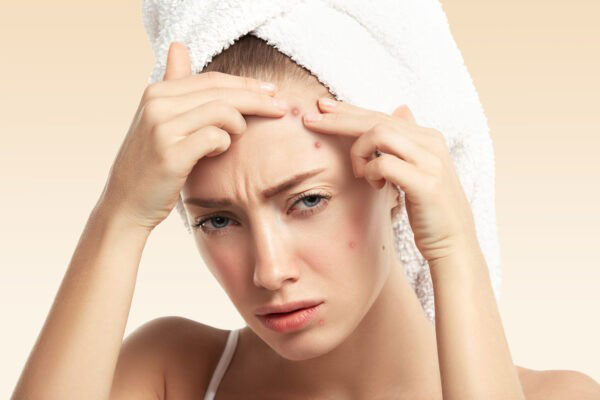 Cách chăm sóc da không bị thâm sẹo sau nặn mụn