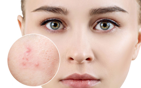 Cách chăm sóc da không bị thâm sẹo sau khi nặn mụn