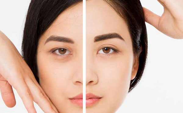 Cắt mí và nâng cung mày cái nào tốt hơn?