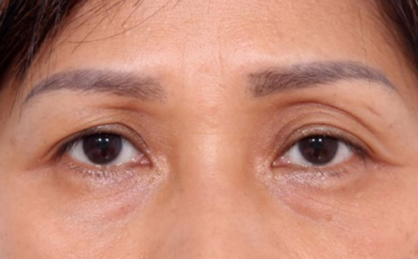 Mắt xếch, mắt lồi, mắt sâu có được cắt mí hay không?