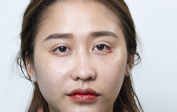 Nguyên nhân dẫn đến việc cắt mí lệch