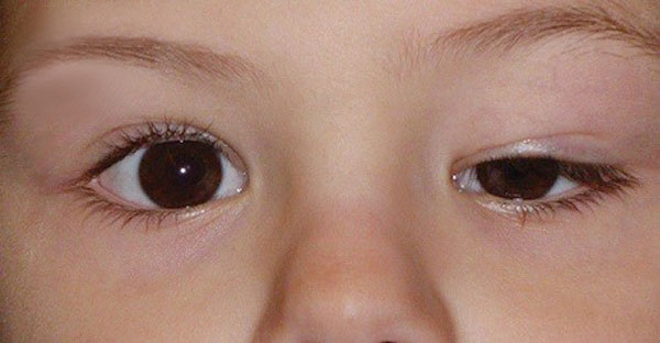 Nguyên nhân gây sụp mí