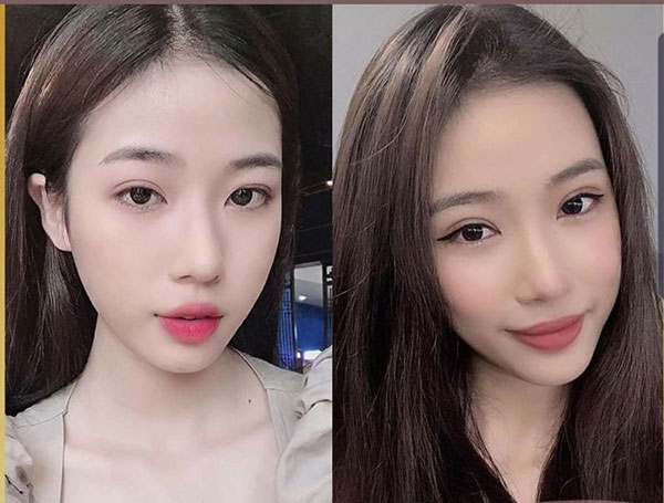 Ưu nhược điểm của cắt mí và nâng cung mày