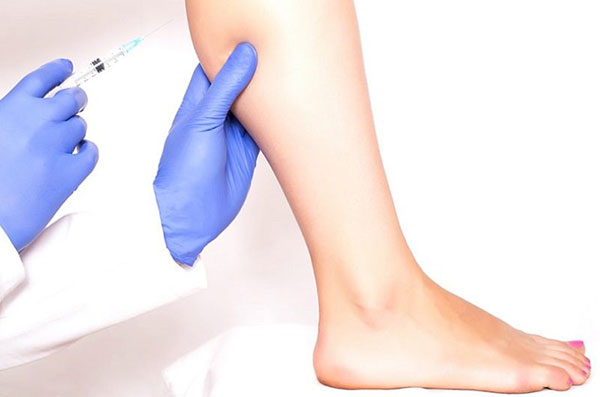 Có nên tiêm botox thon gọn bắp chân hay không?