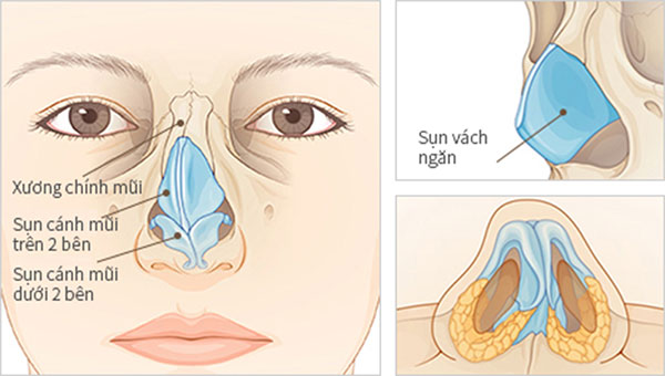 Nâng mũi bằng sụn vách ngăn là gì?