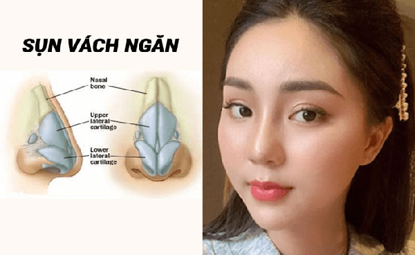 Nâng mũi bằng sụn vách ngăn