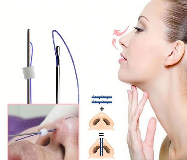Khi nào cần thay chỉ khi nâng mũi?