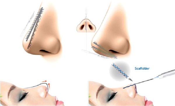 Nâng mũi chỉ có vĩnh viễn không?