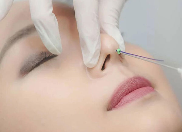 Nâng mũi chỉ có vĩnh viễn không?