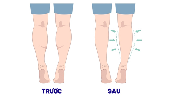 Điều cần biết về tiêm botox thon gọn bắp chân