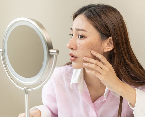 Cách trị nám da cho phụ nữ sau sinh