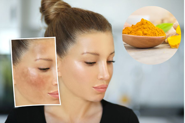 Cách trị nám da bằng tinh bột nghệ