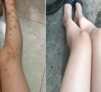 Cách trị nám da ở chân