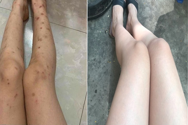 Cách trị nám ở chân