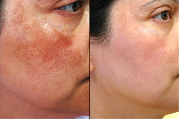 Mùa nào trị nám da hiệu quả nhất?