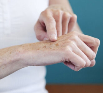 Da tay nổi đốm nâu như đồi mồi liệu có nguy hiểm