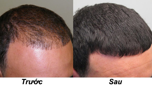 Trị hói đầu tại Hải Phòng