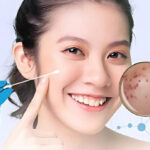 Chấm tàn nhang có hiệu quả không? Khi nào nên chấm tàn nhang